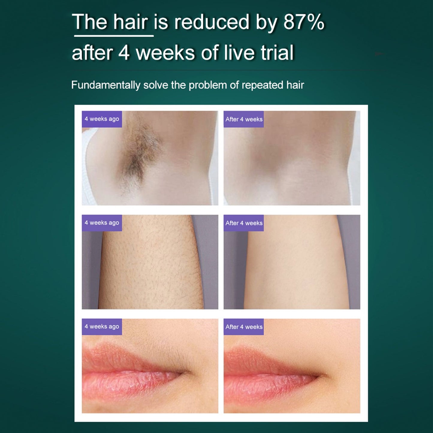 IPL Hair Removal Machine Suitable for Home Use